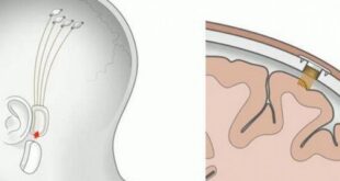 Neuralink de Elon Musk Reinicia Implantes Cerebrales en Humanos: Promesas y Controversias