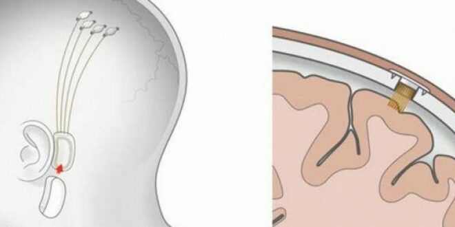 Neuralink de Elon Musk Reinicia Implantes Cerebrales en Humanos: Promesas y Controversias