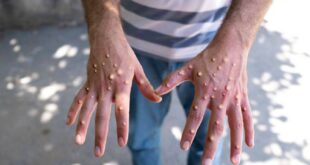 Mpox: Síntomas y Propagación de la Emergencia Sanitaria Mundial