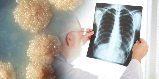 China nos vuelve a Infectar ahora con Tuberculosis Beijing