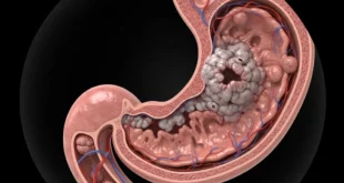 Cáncer de estómago en menores de 50 años: Una alerta médica por el aumento de casos en jóvenes