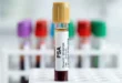 Tubo de ensayo con muestra de sangre para examen de PSA prostático