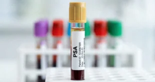 Tubo de ensayo con muestra de sangre para examen de PSA prostático