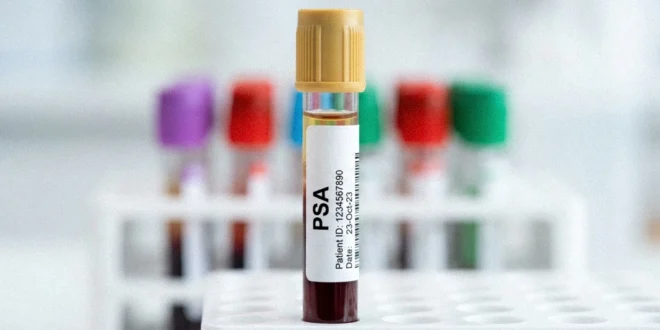 Tubo de ensayo con muestra de sangre para examen de PSA prostático