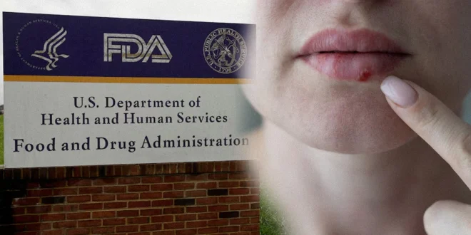 Aprobación de la FDA del pritelivir (HOVILPRI) para el herpes resistente