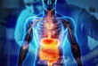 Síndrome de Intestino Irritable (SII) y criterios Roma V